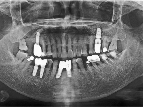昆明美奧種植牙