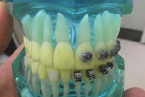 懷化雅貝康口腔正畸模型