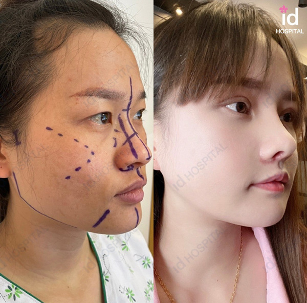 韓國(guó)id整形醫(yī)院隆鼻整形