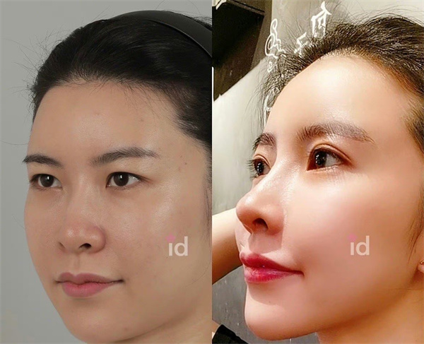 韓國id整形醫(yī)院