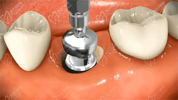 植牙要補(bǔ)骨粉