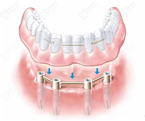 ALL-ON-4全口種植
