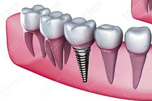即刻種植牙和普通種植牙區(qū)別