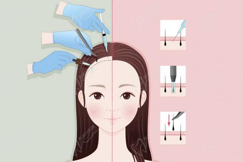 重慶萊森植發(fā)技術(shù)豐富