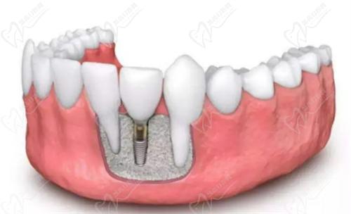 武漢中諾口腔劉博聞醫(yī)生做種植牙技術(shù)嫻熟