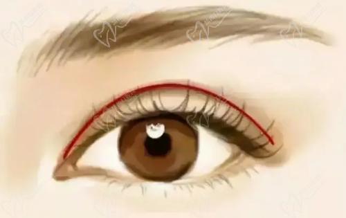 安康維美麗莎美容彭以建的雙眼皮技術(shù)扎實