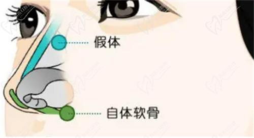 安康維美麗莎美容彭以建隆鼻技術(shù)也不錯