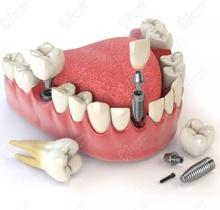 北京圣貝口腔種植牙原三甲醫(yī)院劉希云主任親診,帶全瓷冠4980