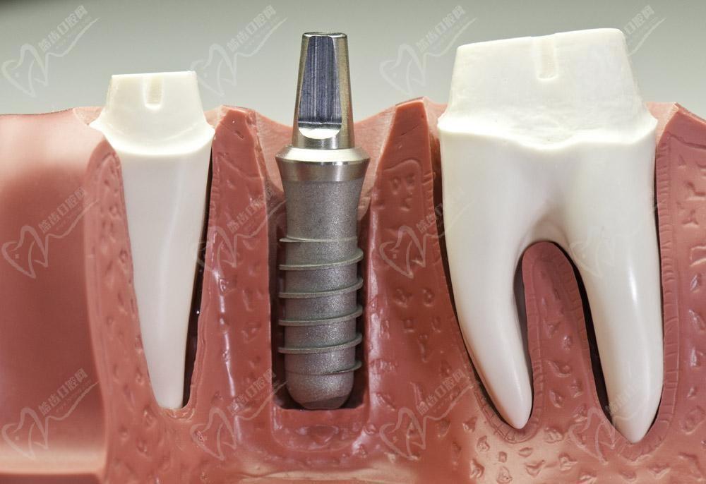 2021種植牙多錢1顆？3k-4k種植牙能用么？低價種植牙的秘密！