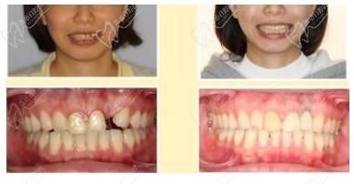 花12800元，找寧波拜博口腔林東杰做德系種植牙價格貴嗎？