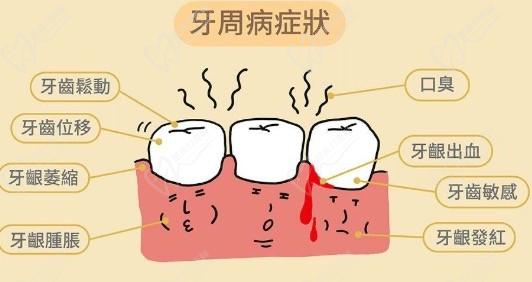 牙周疾病的發(fā)展過(guò)程和治療方法，怎樣才能有效預(yù)防？