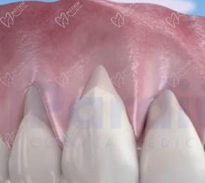 牙齦萎縮牙根外露怎么治療？根面覆蓋術(shù)能恢復(fù)么？