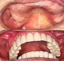 江西九江中山口腔醫(yī)院怎么樣?正規(guī)嗎?分享種植牙案例及價(jià)格