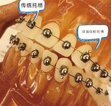 OBrace球面自鎖托槽與金屬托槽矯正的區(qū)別,球面矯正多少錢?