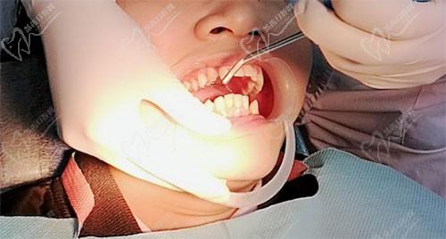 什么？齦下刮治為什么要做4次？看來(lái)你并不了解牙周治療。