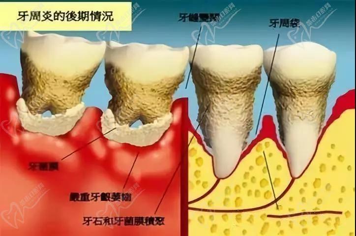 齦下刮治怎么收費(fèi)？怎么判斷自己需要齦下刮治？齦下刮治疼么？