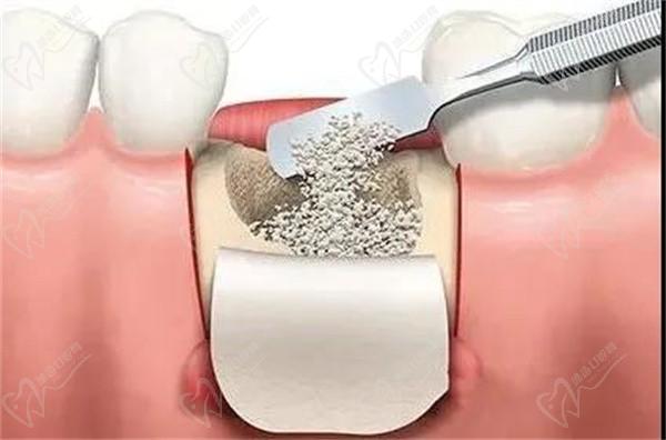 種牙過(guò)程為啥需要骨粉？什么情況才需要補(bǔ)骨粉？