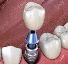 韓國種植牙奧齒泰質量如何？比起登騰哪個好？