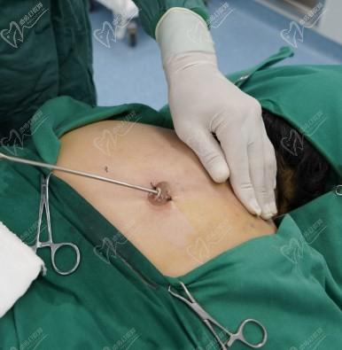 黃學(xué)峰消除富貴包是怎么樣切除的？黃學(xué)峰富貴包的手術(shù)過(guò)程