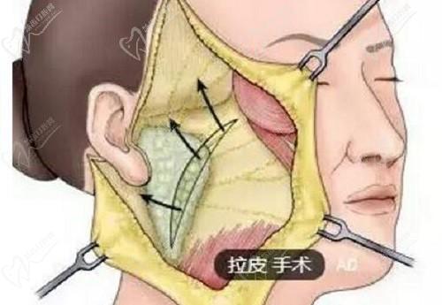 拉皮手術(shù)哪里的整容醫(yī)院做的好？國(guó)內(nèi)拉皮手術(shù)醫(yī)院排名前五推薦